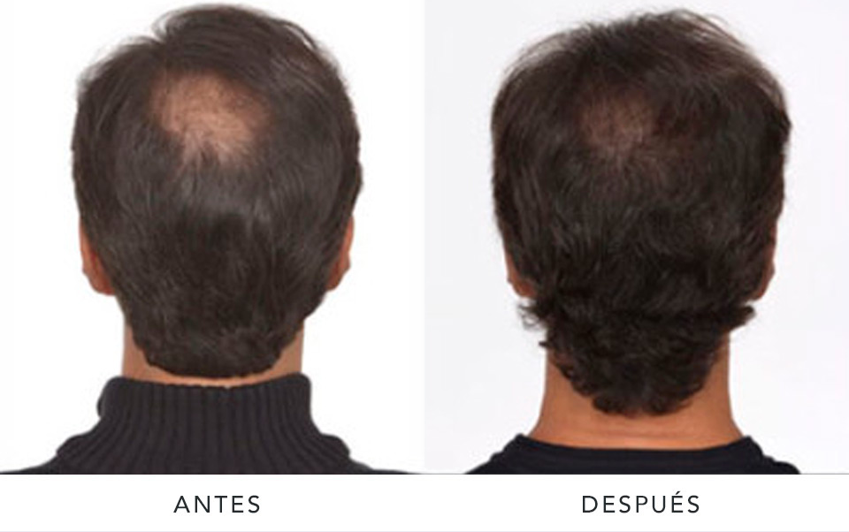 alopecia2-AD