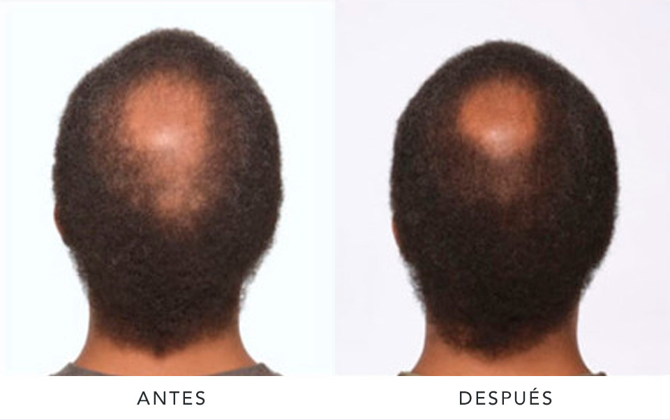 alopecia3-AD