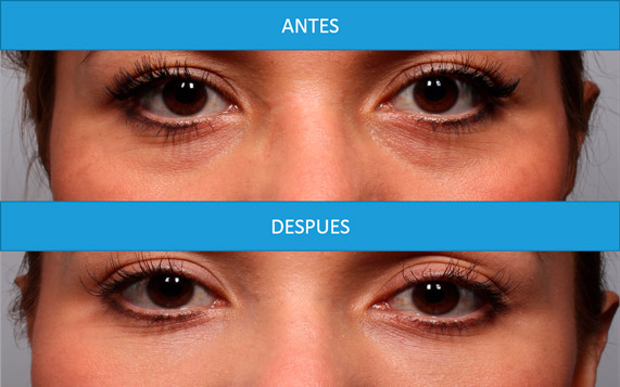 ojeras-yudy-pinzon-2