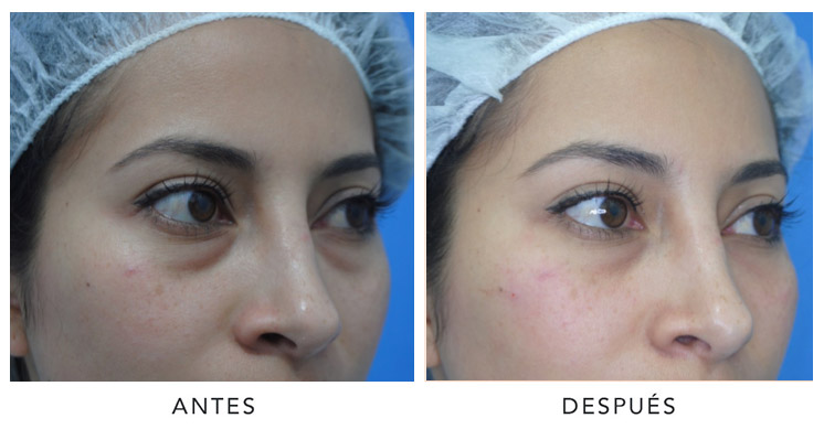 ojeras-yudy-pinzon-3
