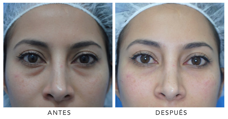 ojeras-yudy-pinzon-4